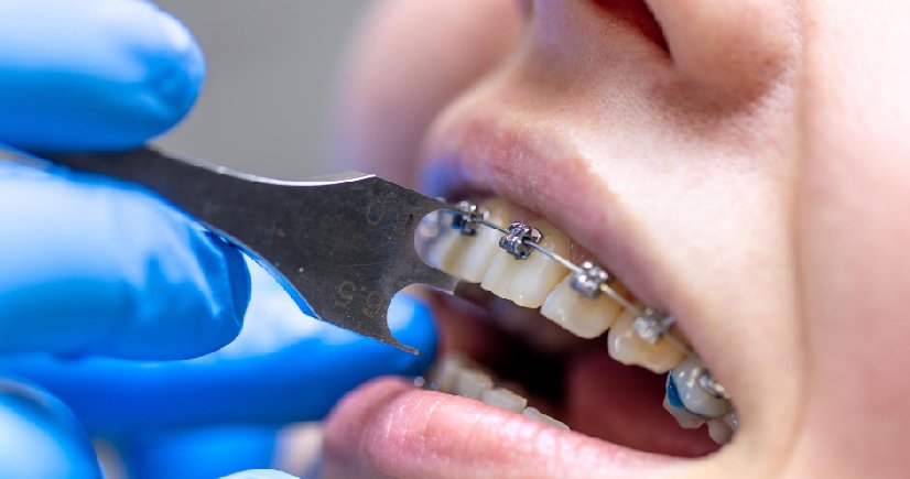 cosmetic dental clinic in bangalore 